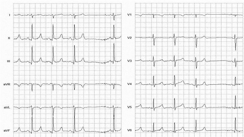 2° SA Block 12 Lead EKG